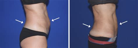 Eine fettabsaugung ist vielmehr ein geeignetes mittel zur verbesserung der körperform. Fettabsaugung am Bauch - Perfekter Körper, 1010 Wien