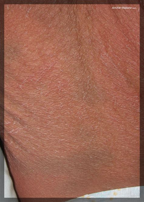 Differentials Itchy Red A Case Of Severe Atopic Dermatitis