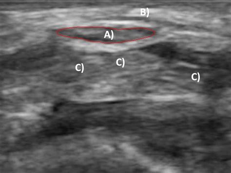 Transverse Ultrasound Image Of The Carpal Tunnel A Traced Median