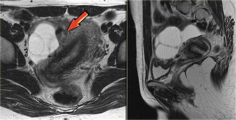 § cystic lesion with the ovary either at the margin or suspended within the lesion. The Radiology Assistant : Ovarian Cysts - Common lesions