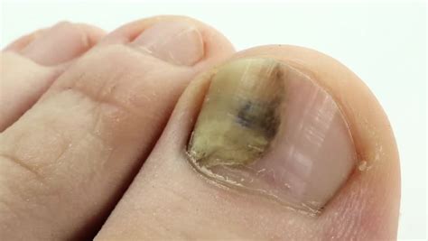 Bruise Under The Nail Of Big Toe Injury To The Nail Sick Nail