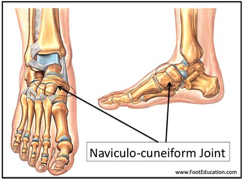 Naviculocuneiform Arthrodesis Footeducation