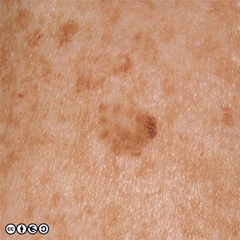 Melanoma Skin Cancer Lesions
