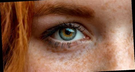 The Difference Between Freckles And Moles What You Need To Know