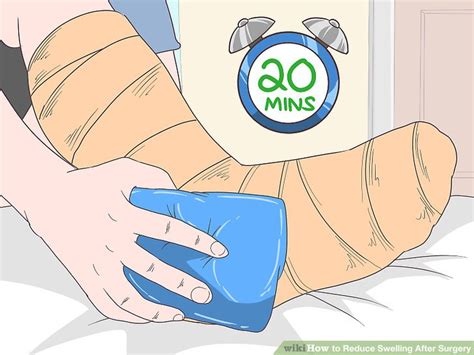 3 Ways To Reduce Swelling After Surgery Wikihow