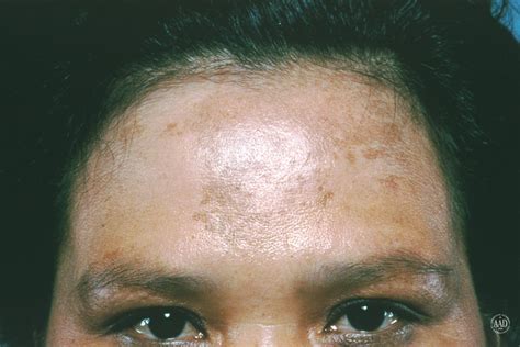 Age Spots On Face Or Cancer Top Secret Skin Tips