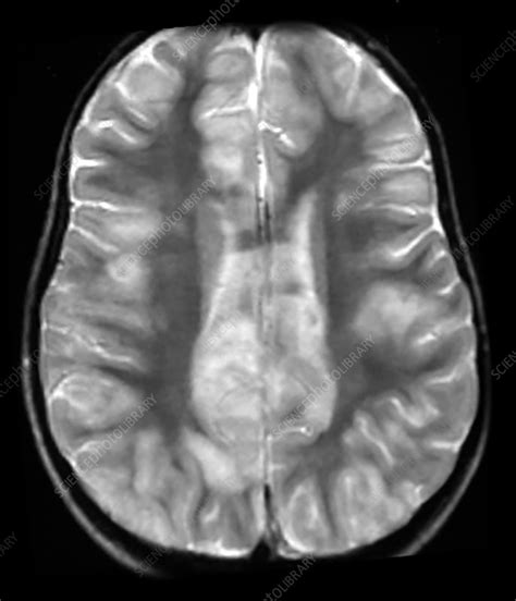Mri Of Adem Stock Image C0435534 Science Photo Library
