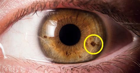 Or words, sentences containing nonsense, untrue.? Do You Have a Spot on Your Iris? THIS is What it Means ...