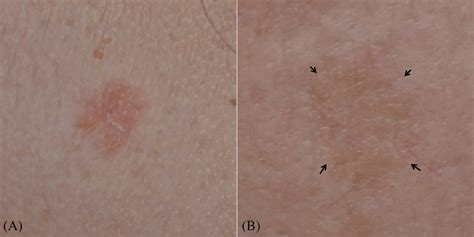 A Classic Benign Lichenoid Keratosis Presents As A Welldemarcated