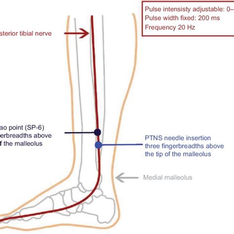 Pdf Effectiveness Of Percutaneous Tibial Nerve Stimulation In The