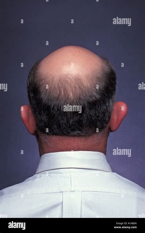 Back View Of Man With Bald Spot On Head Wearing White Shirt Stock Photo