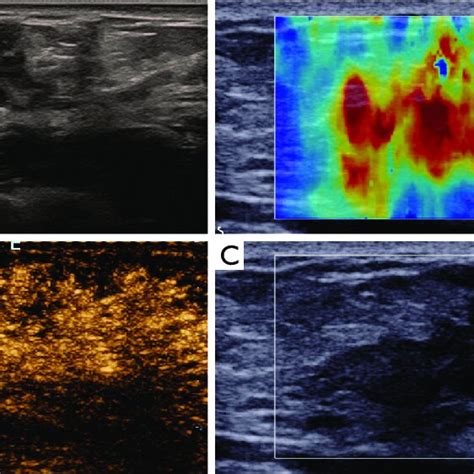 Multimodal Ultrasound Images Of A 35 Year Old Woman With Invasive