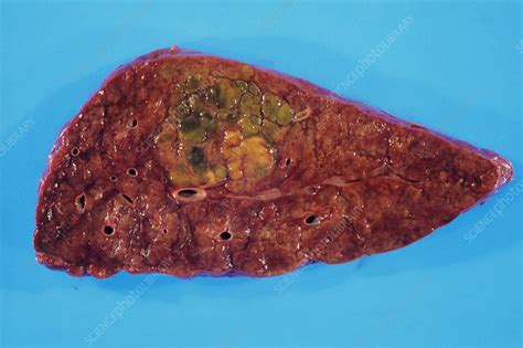 Liver Cancer Stock Image M1310612 Science Photo Library