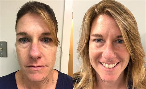Dermatologist Before And After