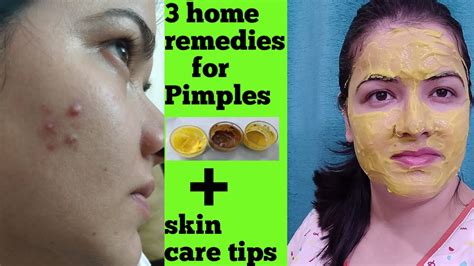Remove Pimples With Home Remedies Three Natural Home Remedy For