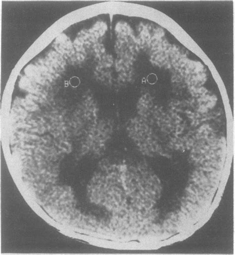 Ct Scan Case 3 Cortical Atrophy And Marked White Matter Hyperlucency