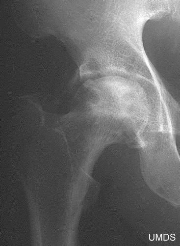 Avascular Necrosis Of The Hip Symptoms Avascular Necrosis Radiology