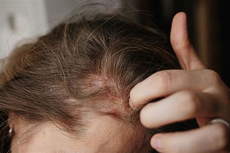 A Comprehensive Guide On Scalp Psoriasis