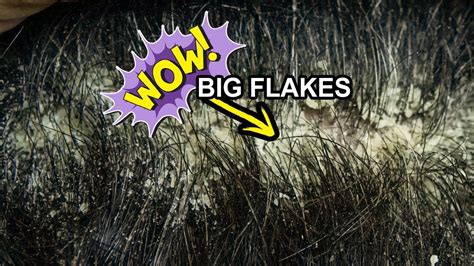 Dandruff Big Flakes Scratching Off Scalp Psoriasis Dandruff Removal