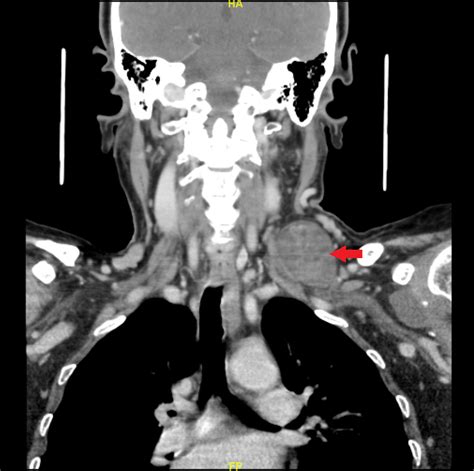 Supraclavicular Lymph Nodes Ct Imaging Of Head And Neck Lymph Nodes