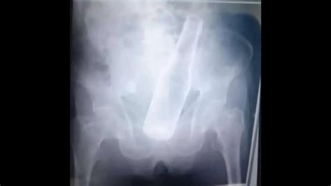 Man With Beer Bottle Stuck In Rectum Says Thieves Did It As They Couldn T Find Valuables To