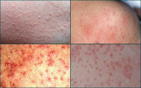 15 Effective Home Remedies To Treat Heat Rash Quickly Home Remedies Blog