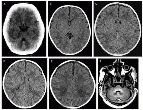 Normal Development Of The Fetal Neonatal And Infant Brain Skull And