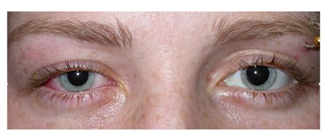 Red Eye Episcleritis Scleritis Eye Surgery Ltd