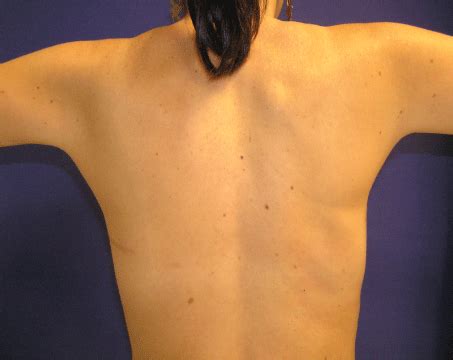 A Minimally Invasive Strategy For Breast Reconstruction Latissimus