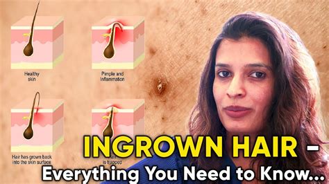 Ingrown Hair Everything You Need To Know Youtube