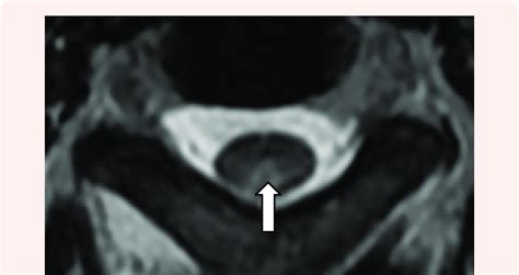 Mri Cervical Spine T2 Weighted Image Axial View Showing Hyperintense