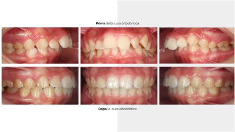 Studio Dentistico Balestro Malocclusione Di II Classe Div 1