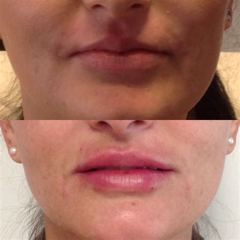 Dermal Fillers The Pros And Cons Justinboey