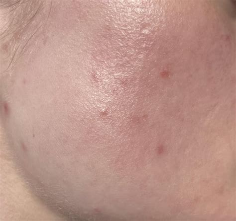 Persistent Cystic Acne On Cheeks Racne