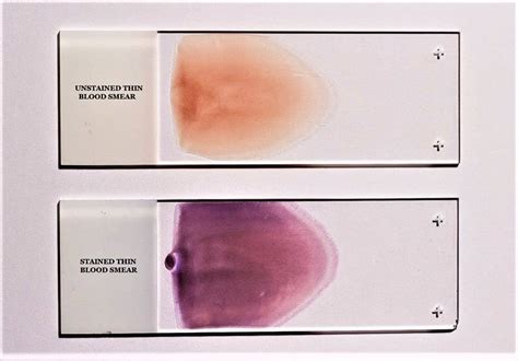 Giemsa Staining Technique Principle Preparation Procedure Results