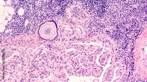 Metastatic Papillary Thyroid Carcinoma Cancer Involving A Lymph Node