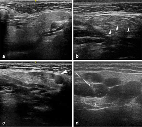 Ultrasound Images In Gray Scale Of Submandibular Glands From