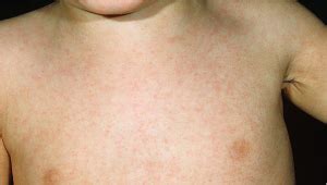 It is a viral infection in adults caused by the virus which causes chicken pox in children. What You Need to Know About Childhood Viral Rashes | Baby Pibu