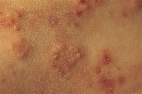 Dermatitis Herpetiformis Coeliac Uk Sg Web