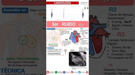 S3 Heart Sound Tercer R3 Ruido Cardiaco SemiologÍa FÁcil