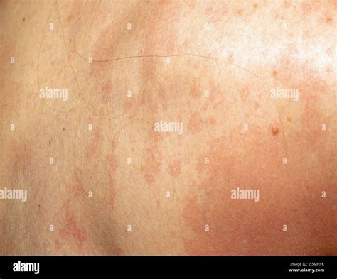 Itchy Scaly Rash Hi Res Stock Photography And Images Alamy
