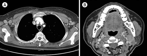 Computed Tomography Ct Scans Show Multiple Lymphadenopathies In Both