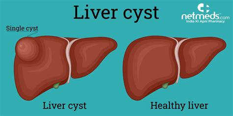 Liver Cyst Causes Symptoms And Treatment