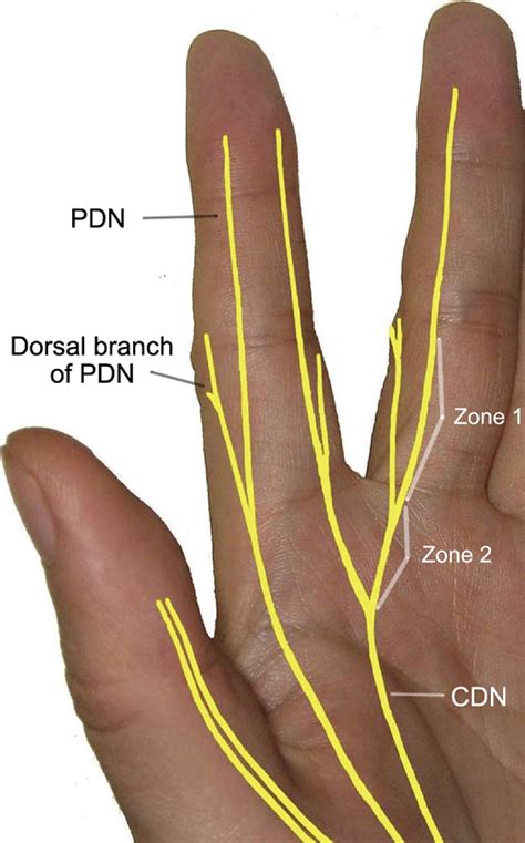 Finger Sensory Reconstruction With Transfer Of The Proper Digital Nerve