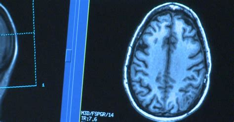 Trial Shows Poliovirus May Be Effective In Treating Deadly Brain Cancer