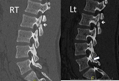 The Value Of Bone Scan And Pars Injection In Nonadjacent Pars Fractures