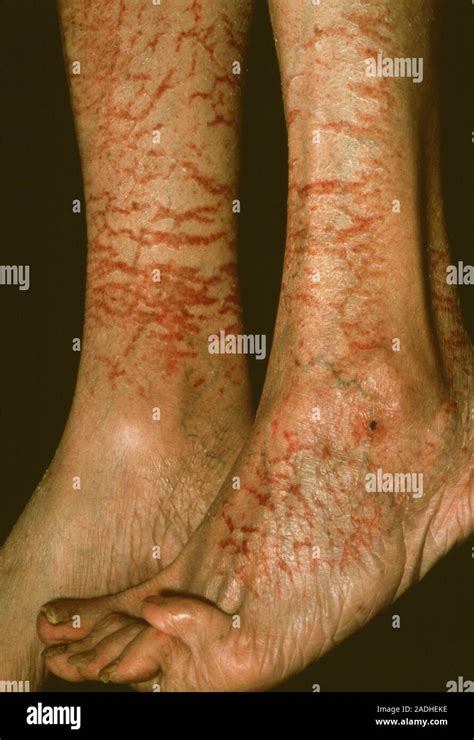 Asteatotic Eczema Dry And Cracked Skin On The Legs Of An Elderly