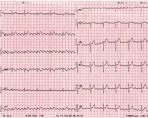 Intermittent Changing Axis Deviation With Intermittent Left Anterior