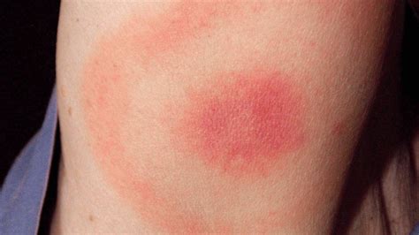 Lyme Spreading Ticks Becoming So Common In Some Areas That Many Places