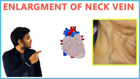 jugular venous pressure causes for enlargement of neck veins bulging of neck veins rjds